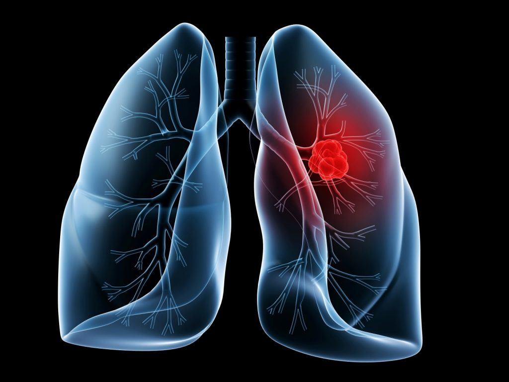 Lung cancer